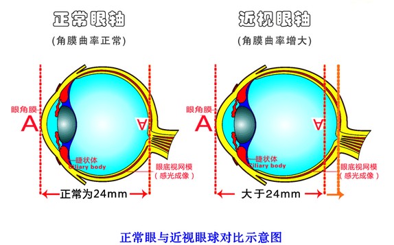 开篇:什么是近视眼矫正手术?